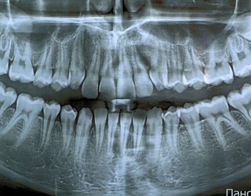 ИИ – самый лучший рентгенолог?